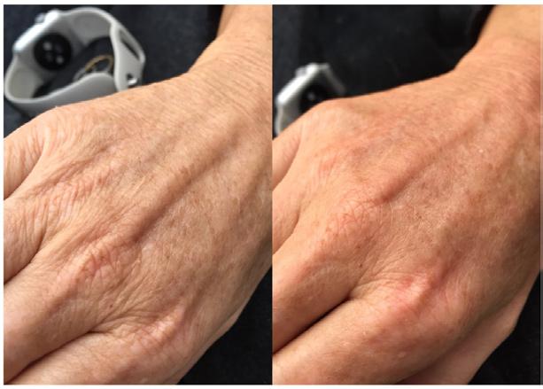 25mm and has no downtime and is practically pain free thanks to the use of plastic needles, making this less invasive than other skin needling