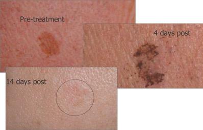 Laser Treatments Cost per session Laser Vein Removal From 80 Laser can be used to remove thread veins on the face