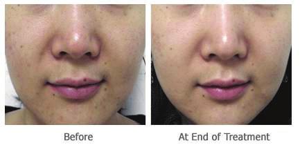 texture, Pimples and pores After Improvement seen especially with skin Texture,
