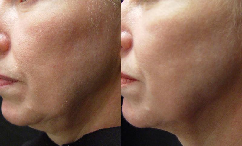 The immediate improvements are a result of existing collagen contraction. The delayed improvements are due to the induction of new collagen formation.