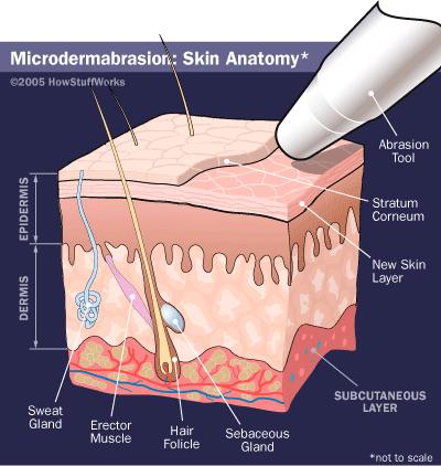 Microdermabrasion Microdermabrasion is a non-invasive "mechanical" exfoliation treatment that removes the outermost layer of dead skin cells on the face, chest, or neck.