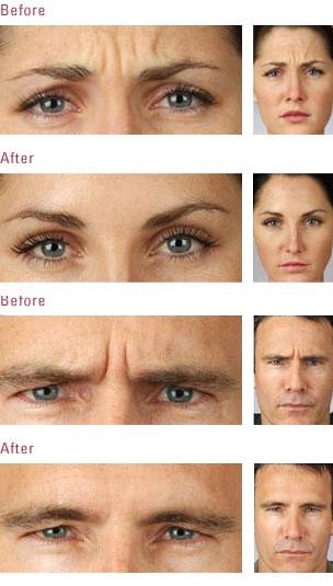 Botox Facial expression lines are created by contractions of the underlying muscles, pulling the skin together when you smile, laugh or frown.