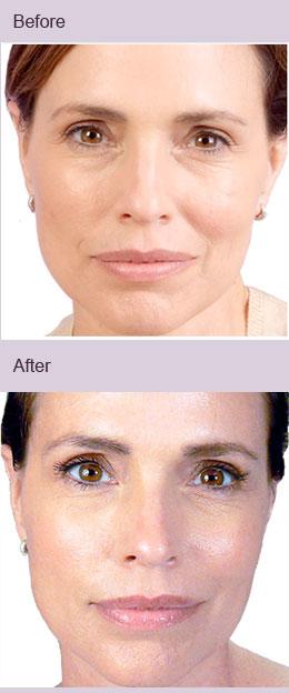 Dermal Filler Wrinkles of the lower face are common and bothersome to many people.