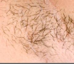 Electrolysis hair removal is recommended for these hair types. The treatments impair the growth capacity of the hair follicles when they are in the active growth stage.