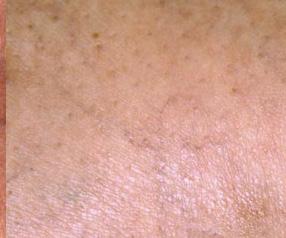 Sclerotherapy is a medical procedure used to eliminate thread/spider veins.