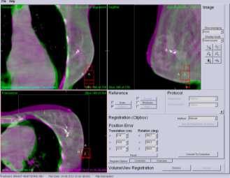 52 HeartSpare IB: CBCT analysis Clip-based match (mm)
