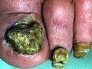 Fungal toenail This is caused by a fungus growing in the nail.
