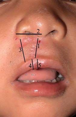 Figure 2 REPAIRED UNILATERAL CLEFT LIP Post-operative picture taken 9 days after cleft lip repair.