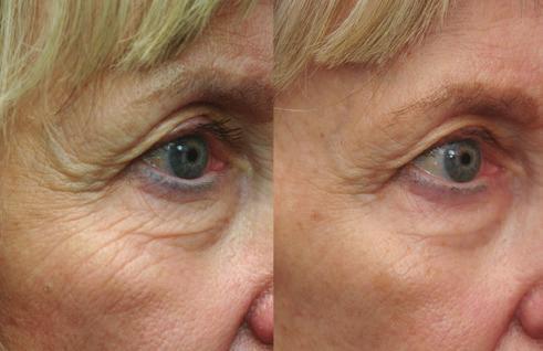 .. FDA-cleared to treat facial wrinkles without