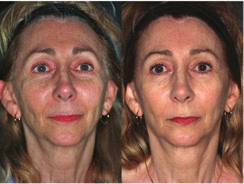 Put a fresh face forward Pellevé precisely heats the deep layers of your skin using advanced radiofrequency energy without damaging the epidermis, or top layer.