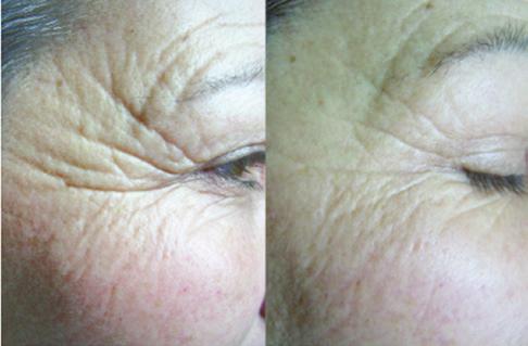 The result is an improvement in skin tightness* and wrinkles you can see and feel.