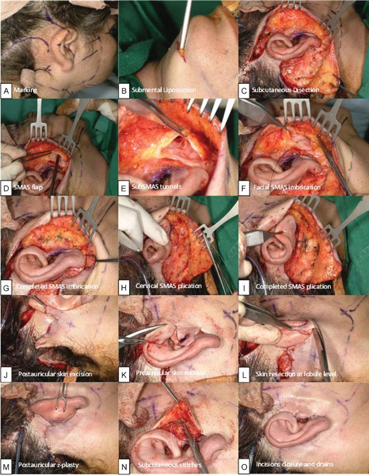 Cervicofacial Rhytidectomy without Notorious Scars Pedroza et al. 235 Fig. 2 Cervicofacial rhytidectomy surgical technique. (A C) Marking and flap dissection.