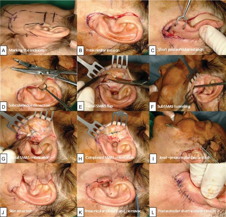 Cervicofacial Rhytidectomy without Notorious Scars Pedroza et al. 239 Fig. 5 Facial rhytidectomy.