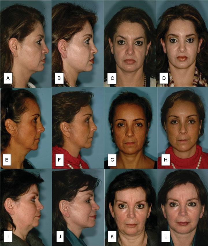Cervicofacial Rhytidectomy without Notorious Scars Pedroza et al. 241 Fig. 7 Cervicofacial rhytidectomy results. Patient 1: (A, C)preoperativestageI,(B, D) postoperative stage I.