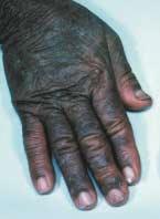 The most commonly affected parts of the body are the fingers