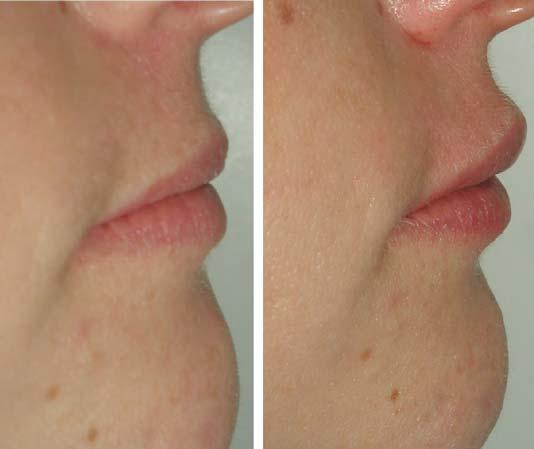 24 niamtu Fig. 16. Most fillers are injected in the intradermal plane. Fig. 14. Lateral view of before (left image) and 2 weeks after (right image) Restylane injection of the upper and lower lips.