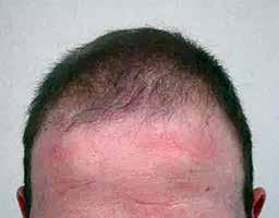 rather than the recipient site. Donor hair follicles transplanted from balding vertex scalp onto nonbald skin continue to miniaturise in synch with follicles on the vertex scalp.