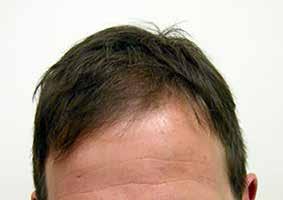 The principle of donor dominance has formed the basis of therapeutic hair transplantation to treat men and women with patterned hair loss.