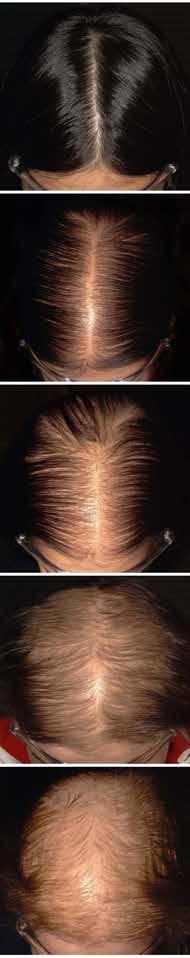 How to Treat Hair restoration Patterned hair loss Epidemiology ANDROGENETIC alopecia affects all men and all women progressively as they age.