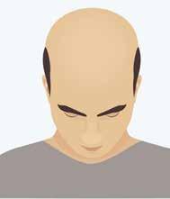 10 Genetic polymorphism of the androgen receptor gene, which is found on the X chromosome, were found to be associated with premature baldness in young men.