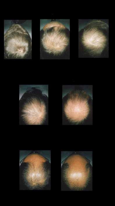 How to Treat Hair restoration from page 18 Pathogenesis Hair on the scalp grows differently from hair elsewhere on the human body.
