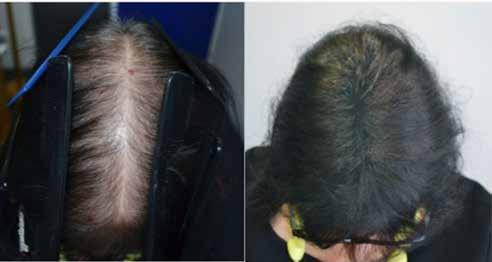 alopecia, these areas are chosen for donor sites. This hair is likely to continue growing for decades.