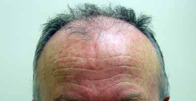 If poor quality donor tissue is used, then balding may occur in the grafts.