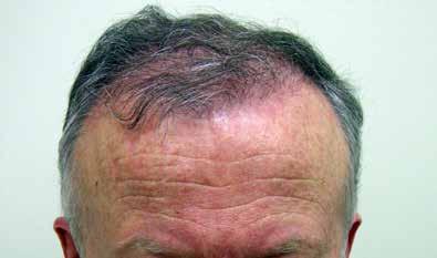 surgery. Without medical therapy, androgenetic alopecia is progressive and repeat operations will be required to compensate for ongoing loss.