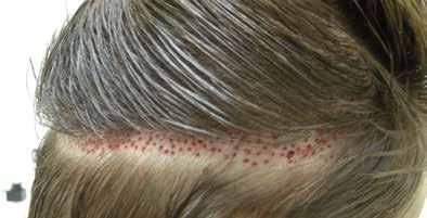 Since finasteride became widely available, fewer than 15% of patients require repeat hair transplantation surgery.
