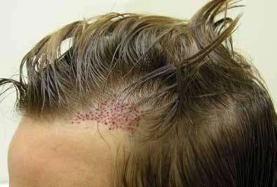 Strip harvesting involves excision of a 10cm long strip of skin from the occipital scalp. Pre-operatively, the hair on the donor site is trimmed short to allow easy access (see figure 7).