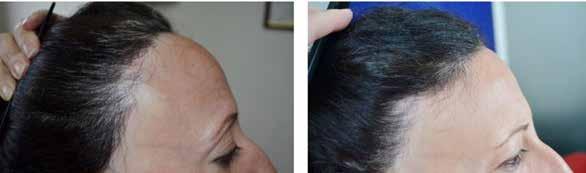 Hair transplants can replicate the natural growth and direction of eyebrow hairs. However, there is no donor hair population that has the exact same growth characteristics as eyebrow hair.