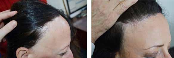 Hair follicle donor grafts are prepared in the same way as for scalp transplantation, except that the hairs are trimmed no shorter then one centimetre long to show the direction of the curl of the