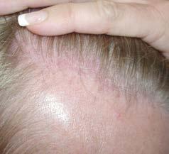 study, extensive regrowth of denser hair occurred, with much less scalp showing through and balding
