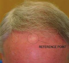 At completion of the clinical study the target area had shown complete regrowth.