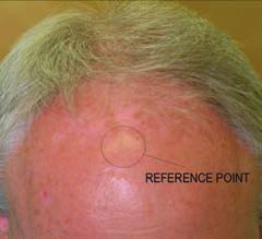 After 26 weeks of HairMax use, he experienced extensive regrowth of hair, especially in the frontal area.