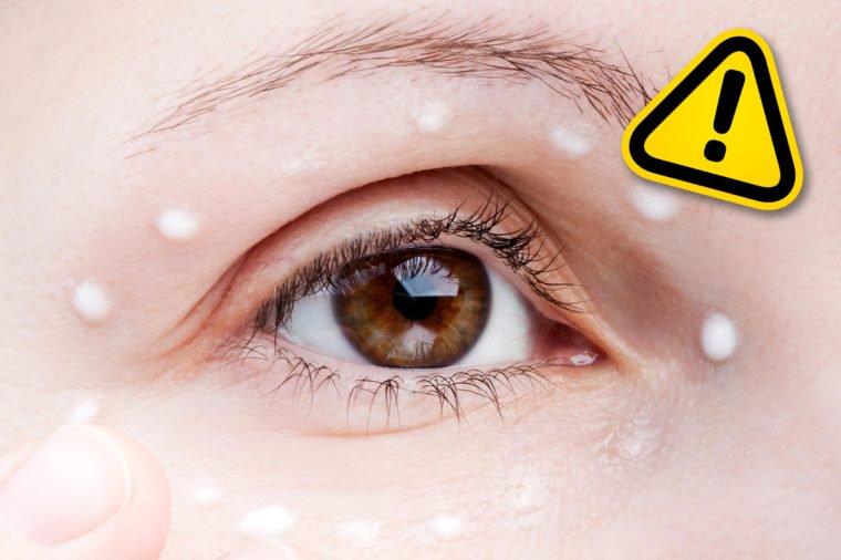 Applying hemorrhoid cream to puffy eyes ILYA ANDRIYANOV/SHUTTERSTOCK No one wants to walk around with under-eye bags and dark circles, but the best remedies involve sleep, hydration, and cooling