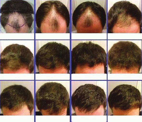 Benefits of Advanced Serum Buested FUE Hair transplant from SQUARE ROOT Benefits of