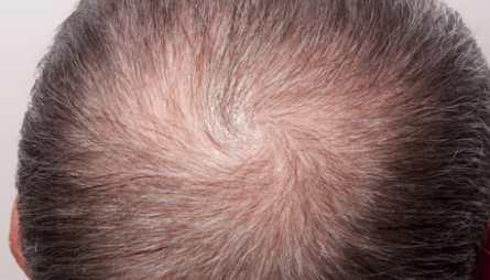 The biggest cause of hair fall is imbalance of a hormone called DHT - Dihydrotestosterone.