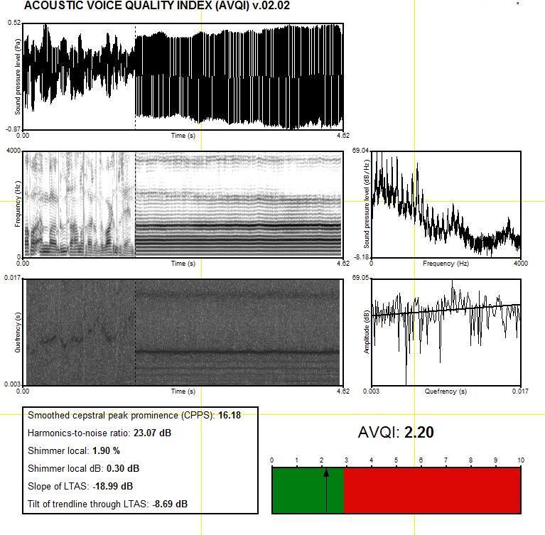 The Acoustic Voice Qualtiy Index (i.e., AVQI) six-factor acoustic model based on linear regression analysis 1. smoothed cepstral peak prominence (i.e., CPPs), 2. harmonics-to-noise ratio (i.e., HNR), 3.
