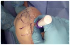 the incision. Press gently to ensure intimate contact of the mesh to the side of the incision.