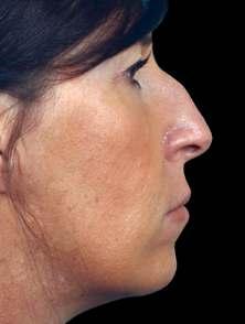 Otherwise, your nose can appear too big or too short and draw too much attention. No face is perfectly symmetrical, but certain asymmetrical features, like the nose, tend to be more evident.