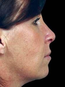 WHAT S YOUR NOSE SHAPE? > SLOPED > STRAIGHT > HUMPED > HOOKED Nasal surgery is the solution for evening and smoothing out humps and bumps on the nose.