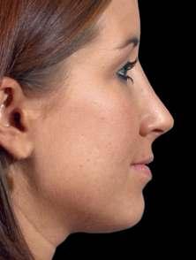 THE TWO RHINOPLASTY TYPES OPEN PROCEDURE An open procedure utilizes an additional incision across the strip of tissue that separates the nostrils to allow your surgeon better visualization.