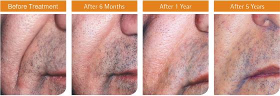 5-YEAR ARTEFILL RESULTS Efficacy at Five Years Compared to Six Months Figure 2. (A) PMMA filler shows marked improvement over collagen at 6 months (po.001).