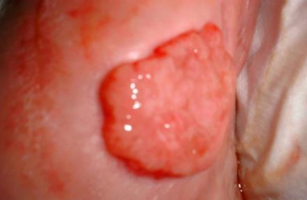 Over-Granulation Description Characterised by proud-flesh occurring after the wound bed has filled with granulation tissue An excessive laying down of new blood vessels creating a bulge of highly