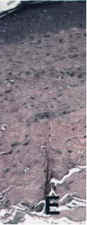 Verhoeff stain demonstrates elastosis in papillary and