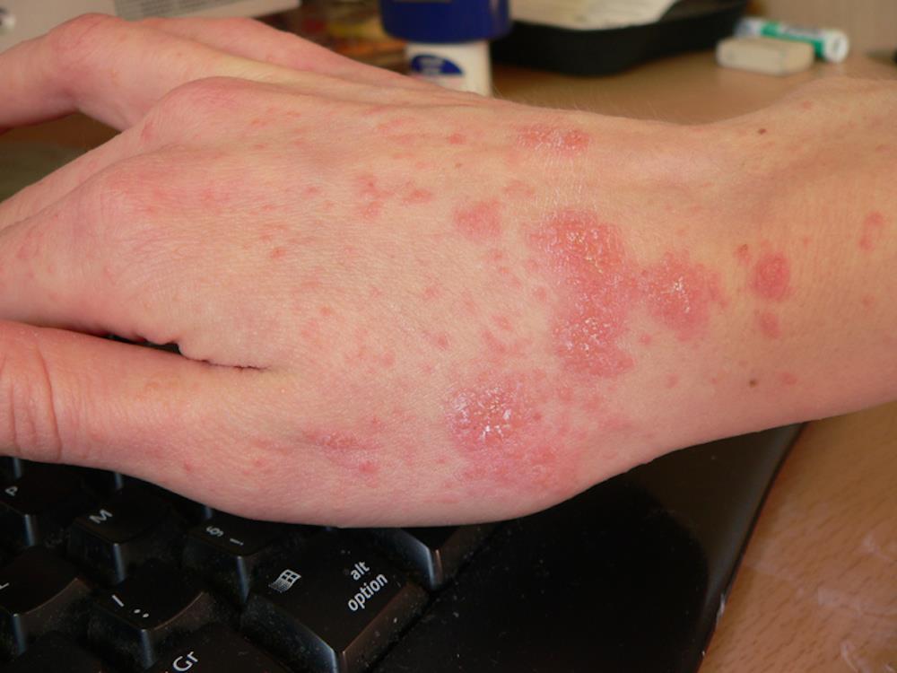 Scabies is a very common skin condition caused by an infestation of mites With this in mind, it is important to be proactive when it comes to diagnosing and treating scabies.