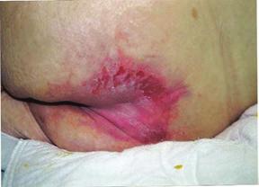 Deep Tissue Pressure Injury Intact or non-intact skin with localized area of persistent non-blanchable deep red, maroon, purple discoloration or epidermal separation revealing a dark wound bed or