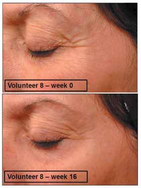 Anti-Aging Benefits Multi-dimensional wrinkle reduction using cream with 1.