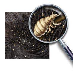 What are head lice? Head lice Nits Kutis Kutu bugs Headlouse Cooties Head lice are small at insects, about 2 3 mm long. They live on the scalp (the skin on a person s head where the hair grows from).